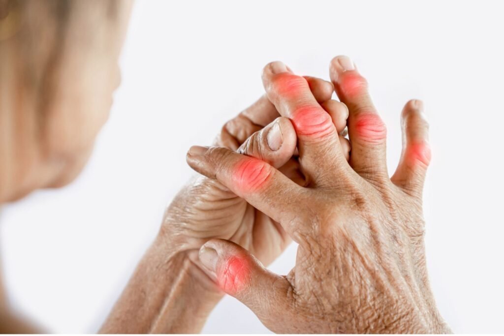 Arthritis in the fingers
