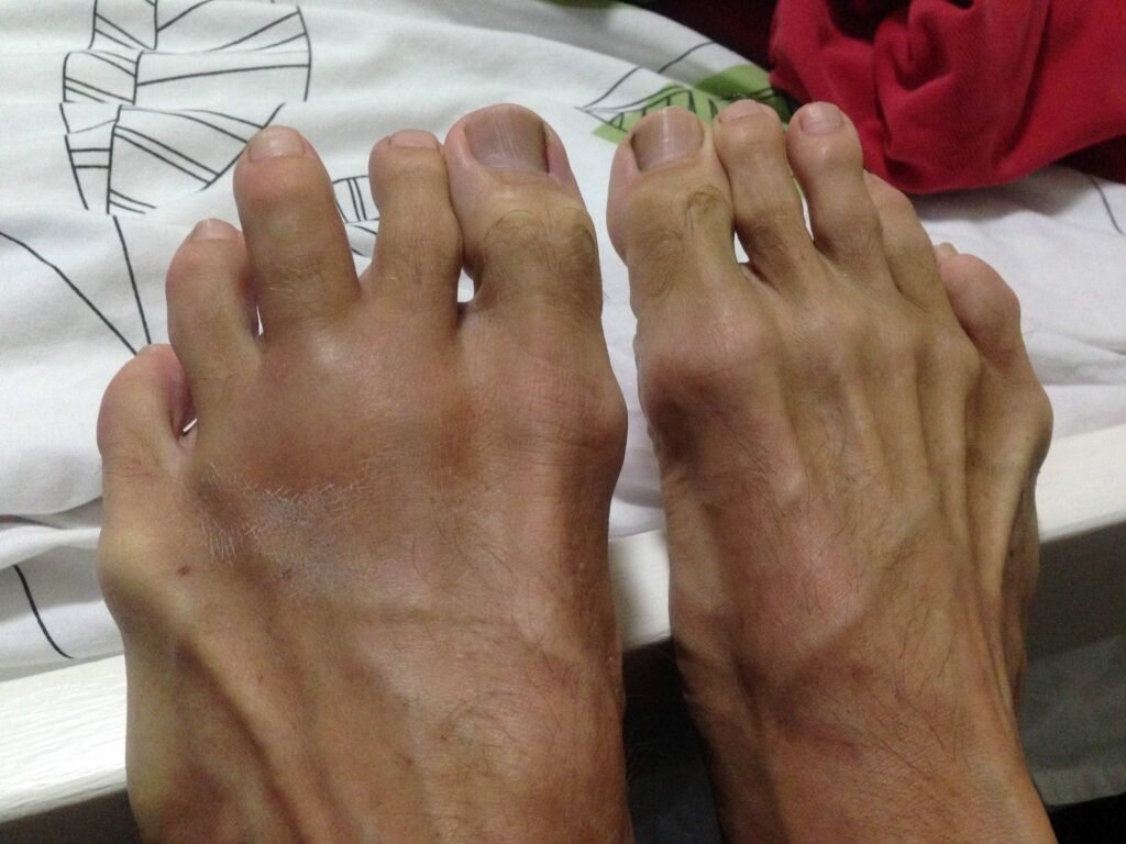 Arthritis in the third metatarsal